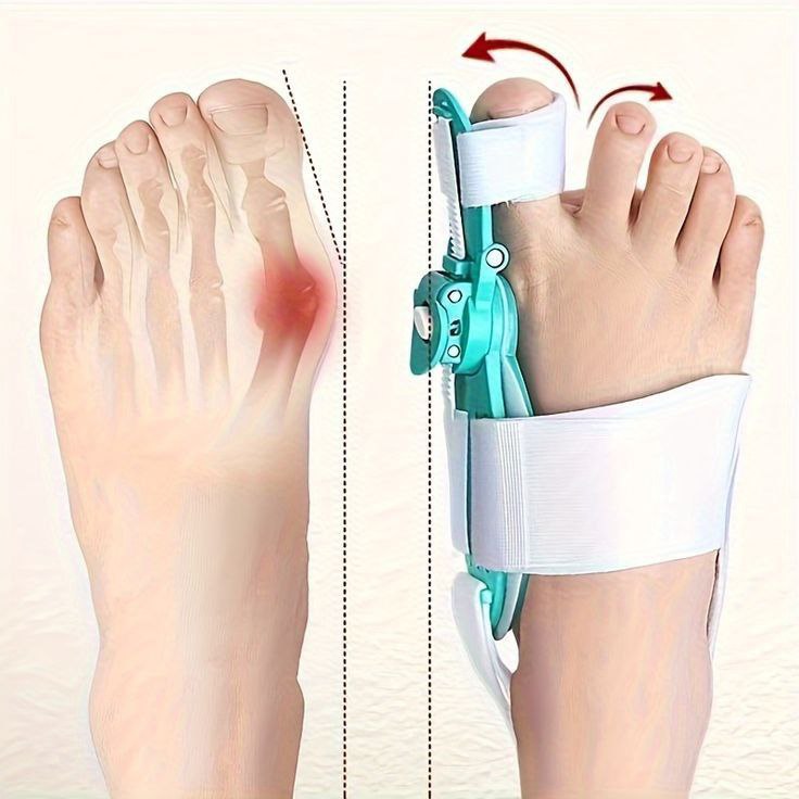 Effective Adjustable Toe Corrector